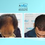 “کاشت مو در ایران نوین تنها با دو و نیم